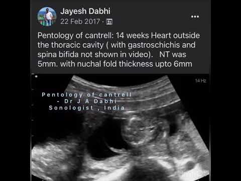 カントレル五部作