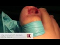 Ingrown Toenail Surgery With Amazing Reults