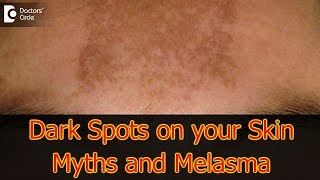 Dark Spots on your Skin | Hormones, Vitamin D, Melasma - Dr. Aruna Prasad