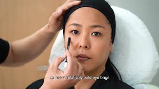 Non-Surgical Methods to Remove Eye Bags