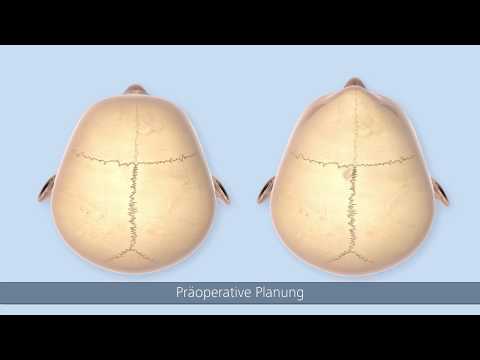 SonicWeld® OP-Technik – Kraniosynostose