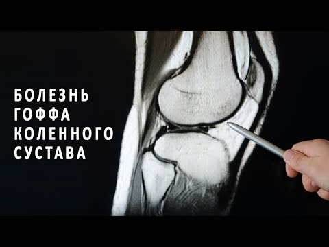 Болезнь Гоффа коленного сустава