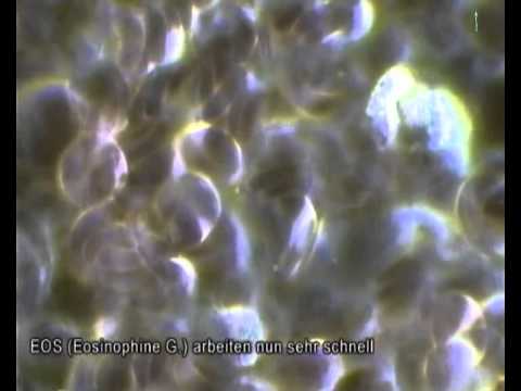 Positive Beeinflussung des Blutes durch SANZA Kombinationstherapie