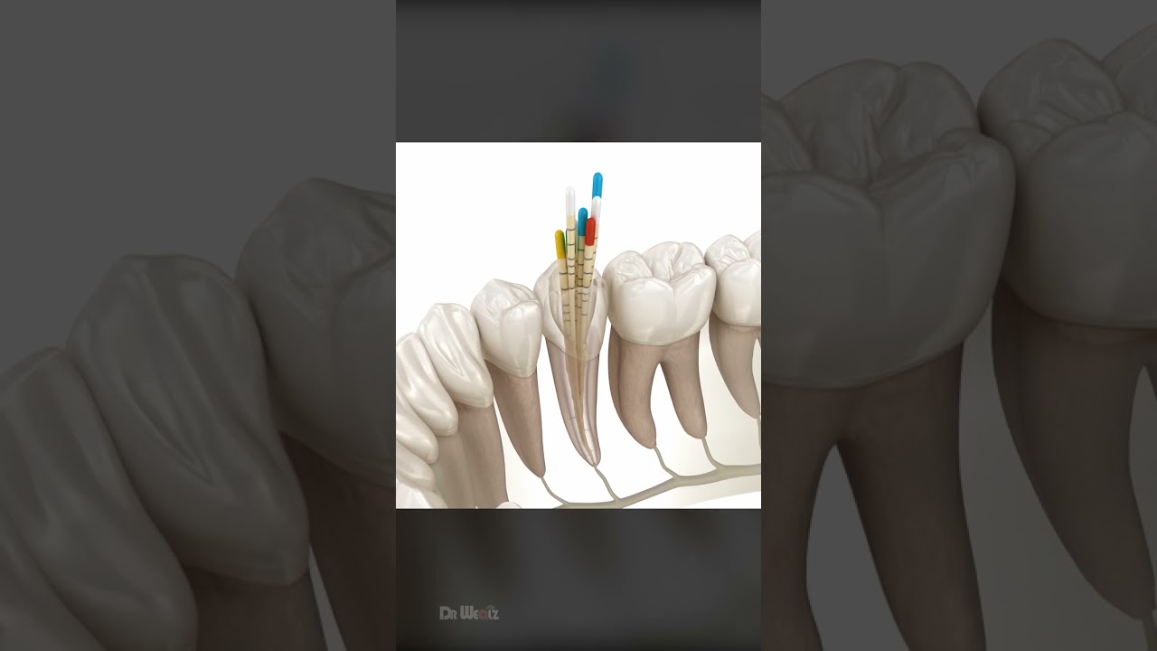 What To Expect During a Root Canal, Is It Right For You?