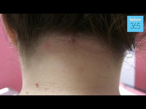 Quale akriderm da psoriasi Purelan da eczema
