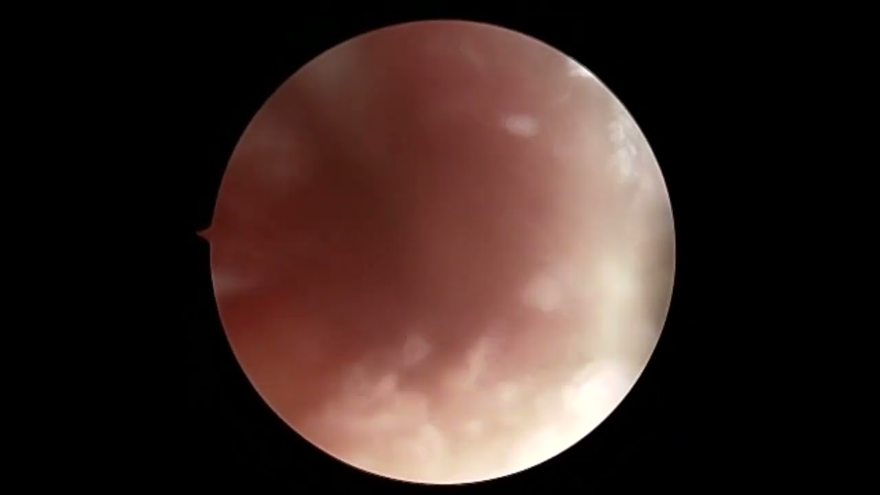 Dr. Garcia’s Updated Quad ACL Reconstruction Technique