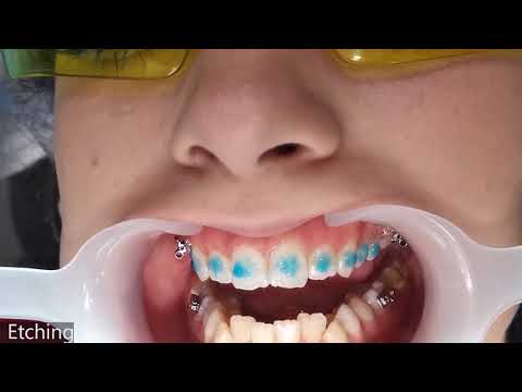 Braces bonding: Putting braces on