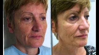 ד"ר אבישי וינברגר - תמונות לפני ואחרי טיפולי הצערת פנים