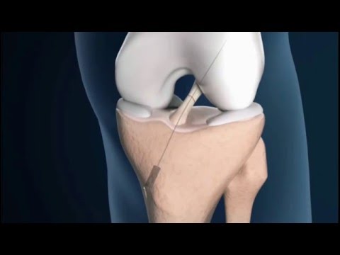 Arthrosen der Schultergelenke Wie Brustwirbelsäule Hernie zu identifizieren