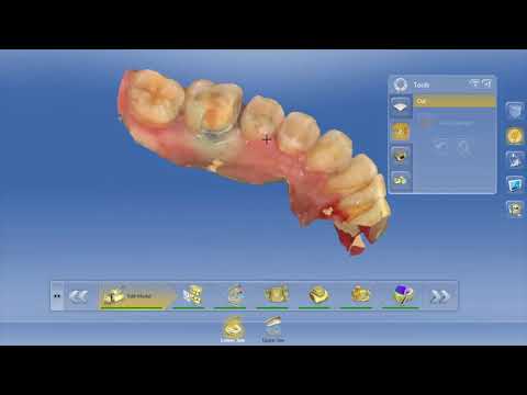 COLTENE’s Cements and Bond Provide Adhesion Options for CEREC® Users