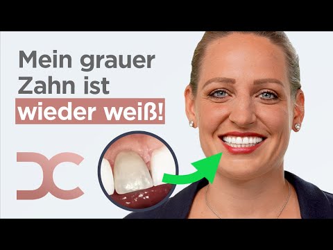 Dunkler Zahn dank Krone wieder weiß!