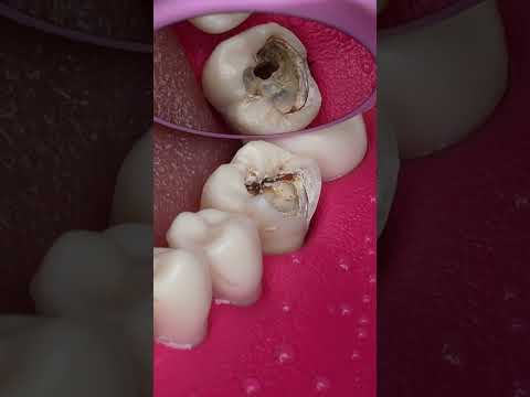 Dentist Looking Tooth Cavity #dentist #satisfying