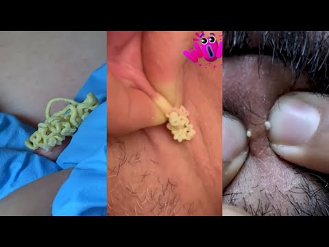 Crazy Popping Pimples And Removal Blackheads And Cyst – Best Pimple Popping Compilation Videos #3
