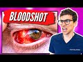 Bloodshot Eyes | What Causes Bloodshot Eyes and How to Get Rid of Them | Doctor Eye Health