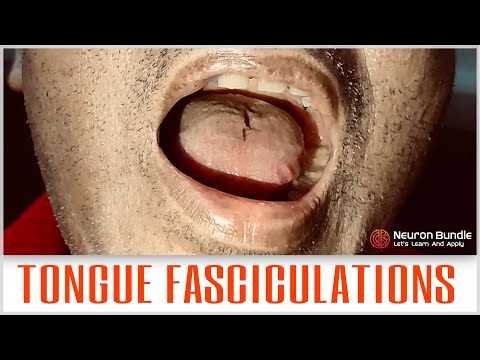 TONGUE FASCICULATIONS #tonguetwitching #motorNeurondisease #ALS #lowermotorneuron #examination