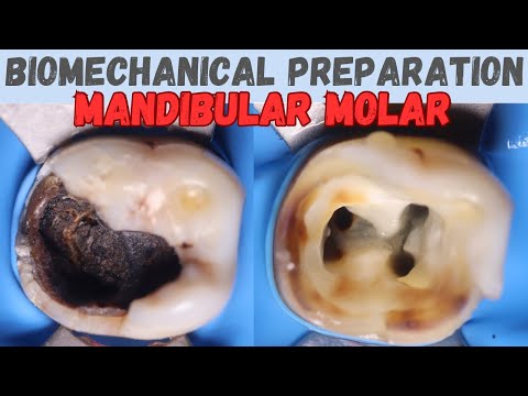 Biomechanical Preparation in Mandibular Molar 