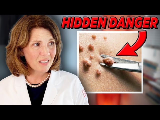 Understanding the Real Cause of Skin Tags and How to Effectively ...