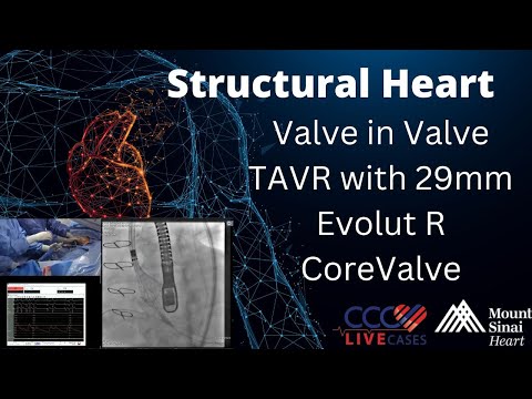 Valve in Valve TAVR with 29mm Evolut R CoreValve - January 8, 2019