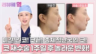 [리뷰혜영] NO보정! 100% 리얼 코 재수술 1주일 후기! l 와이영성형외과