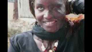 Disfigured Faces Cannot Disguise Beauty - [TRIGGER WARNING]