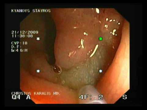 Malignant Polyp Excision From Colon