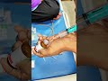 Panta 40 Injection Pulling Entertainment Song Music Varisu Doctor Telugusongs Hospital