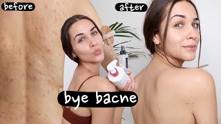 BACNE SKINCARE ROUTINE (back acne) | HOW I GOT RID OF BACNE