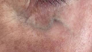 How to diagnose and treat Eyelid Veins: Facial Varicose Veins