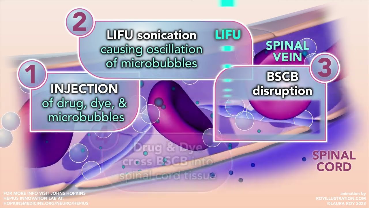 BSCB Barrier: Ultrasonic Drug Delivery Model