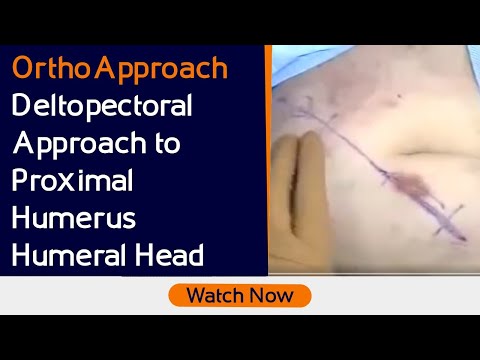 OrthoApproach - Deltopectoral Approach to Proximal Humerus / Humeral Head
