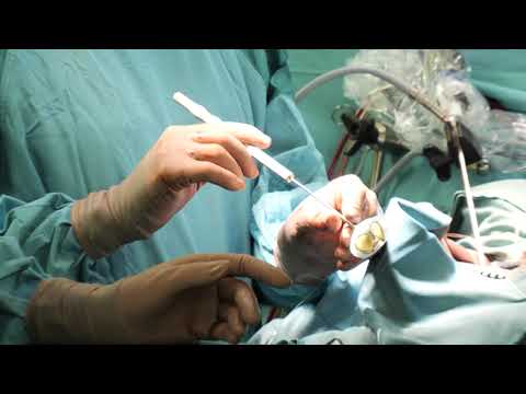 HDZ NRW: Neue biologische Mitralklappenprothese verspricht längere Haltbarkeit