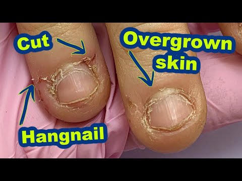 Story Time : Most Painful Client Experience 😖 Bitten Nails Transformation – Winter Nail Art