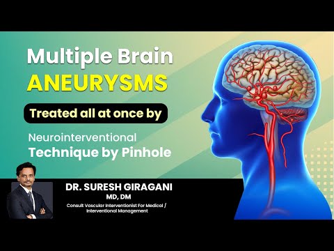Multiple Brain Aneurysms Case: Endovascular Treatment for Ruptured and Unruptured Aneurysms