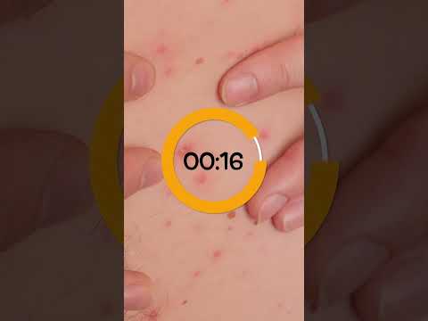 Acivir 200mg Dt Acyclovir Tablet