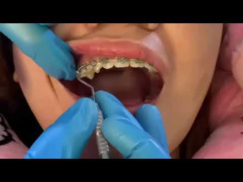 Braces Check up | RAINBOW RUBBER 🌈🏳️‍🌈