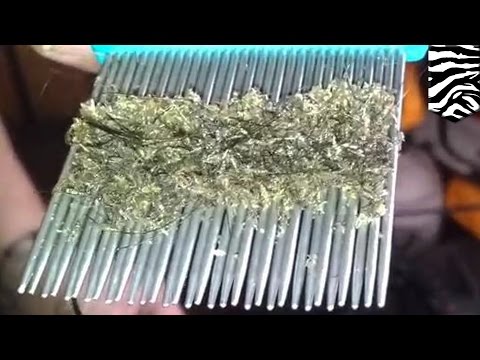 Halamang-singaw kuko sa paa ng sabon Isang mabisang lunas para sa kuko halamang-singaw