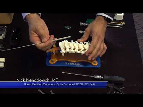 Dr. Nick Nenadovich Talks About Anterior Cervical Fusion vs. Disc Replacement
