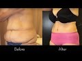 Tummy Tuck Liposuction Beverly Hills Dr Gabriel Chiu
