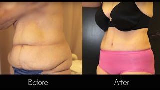 Tummy Tuck | Liposuction | Beverly Hills | Dr. Gabriel Chiu
