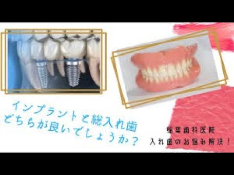 インプラントと総入れ歯　どちらが良いのでしょうか？