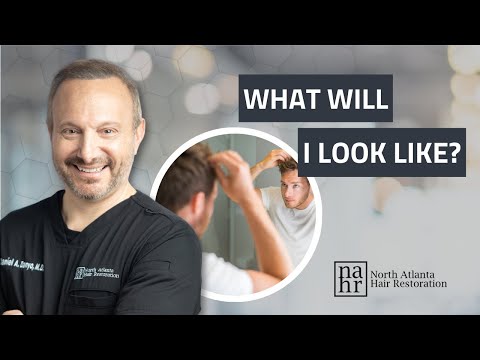 What Does A Beard To Head Hair Transplant Look Like?