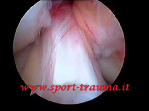 Dolore dopo protesi danca Come si deteriora visione in osteocondrosi