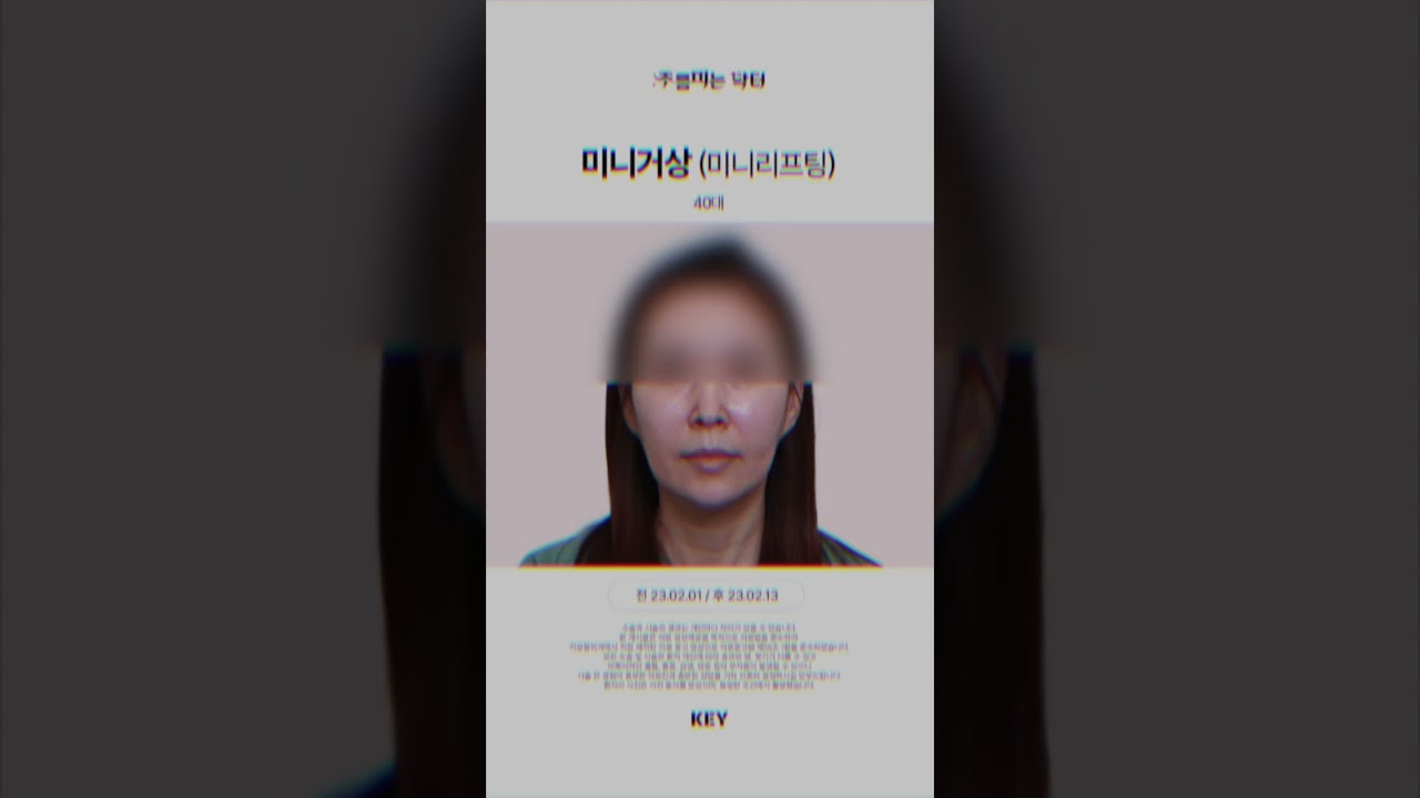 40대의 미니거상 미니리프팅 대구키성형외과