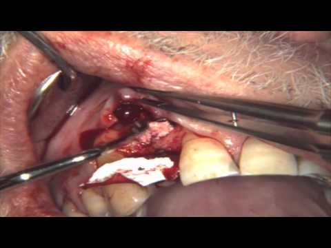 Implant Placement With Simultaneous Bone Augmentation - Case 2