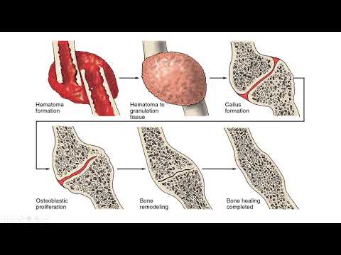 Tratamentul cu sodă pentru artroza genunchiului