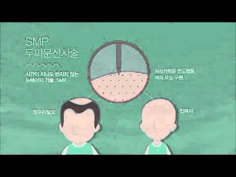 NHI 뉴헤어모발이식 동영상 (탈모치료는 두피문신SMP)
