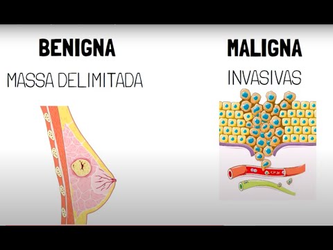 Neoplasia benigna x Neoplasia maligna
