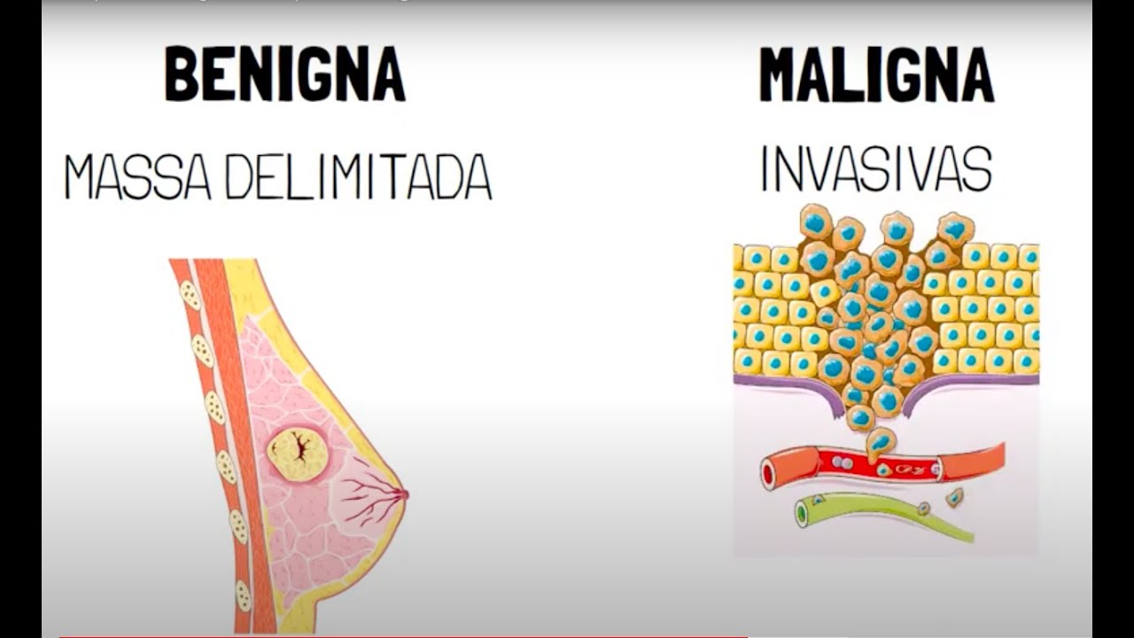 Neoplasia benigna x Neoplasia maligna