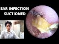 Pus and Dead Skin Suctioned From Ear Canal (Acute Otitis Externa)