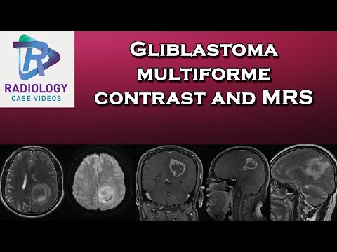 Glioblastoma multiforme contrast and MRS